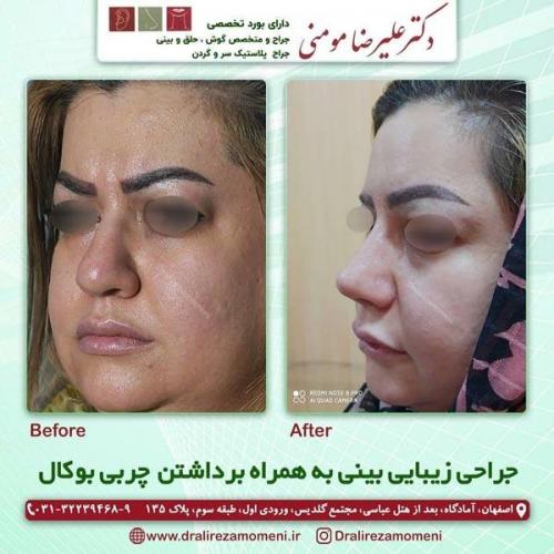جراحی-بینی-195