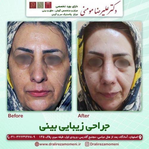 جراحی-بینی-213
