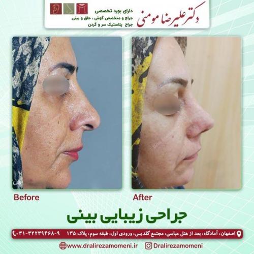 جراحی-بینی-214