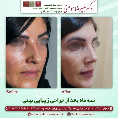 جراحی-بینی-220