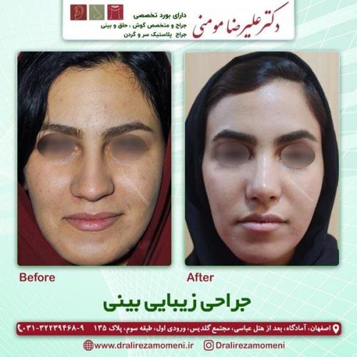 جراحی-بینی-221