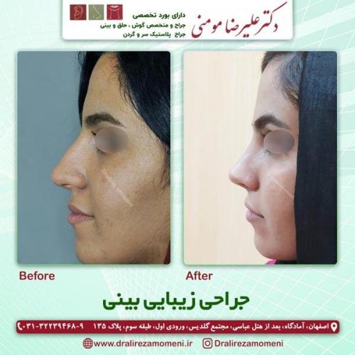 جراحی-بینی-222