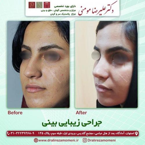 جراحی-بینی-223