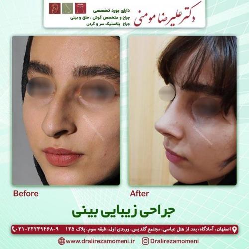 جراحی-بینی-224