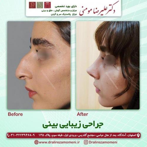 جراحی-بینی-225