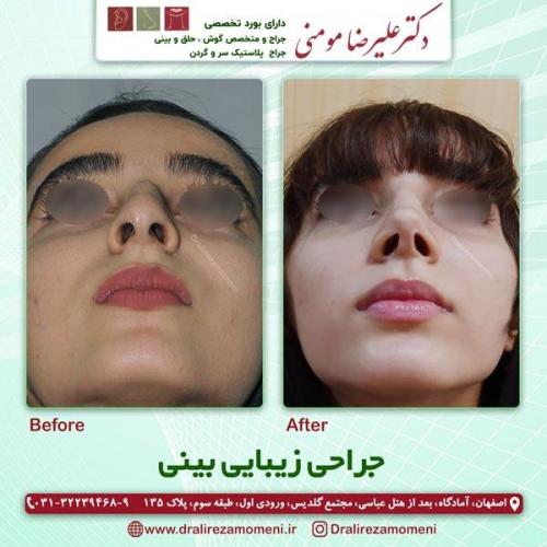جراحی-بینی-226