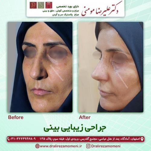 جراحی-بینی-228