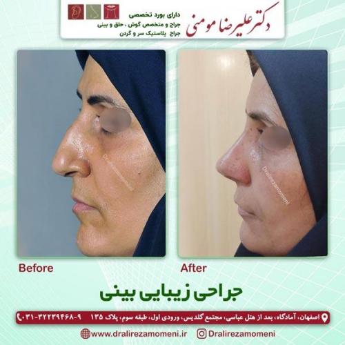 جراحی-بینی-229