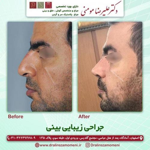 جراحی-بینی-236