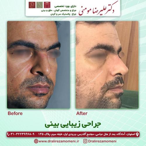 جراحی-بینی-237