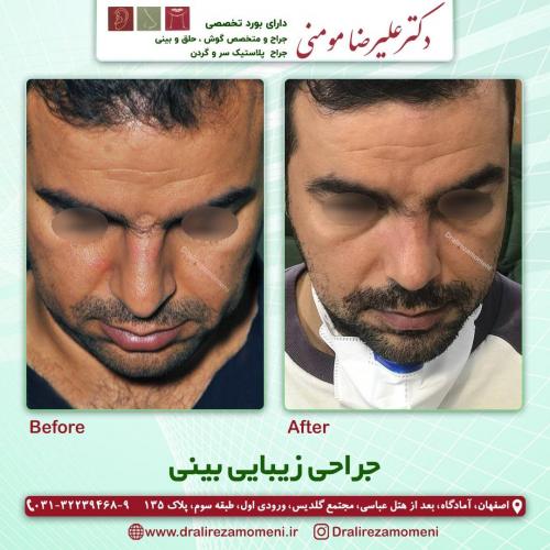 جراحی-بینی-238