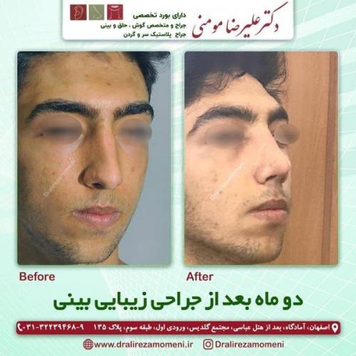 جراحی-بینی-250