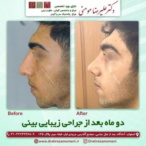 جراحی-بینی-251