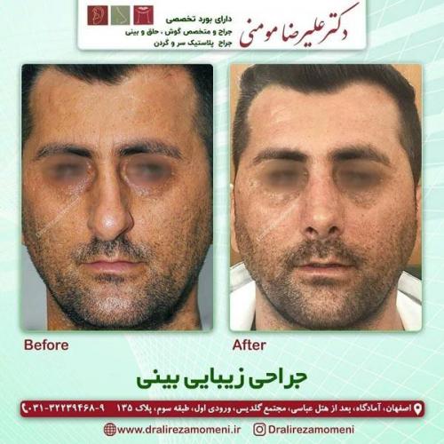 جراحی-بینی-252