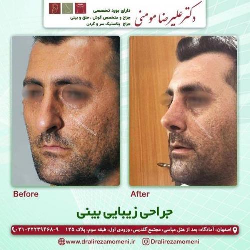 جراحی-بینی-253