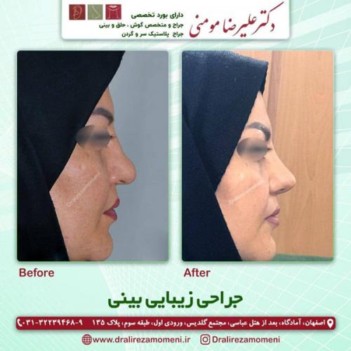 جراحی-بینی-289