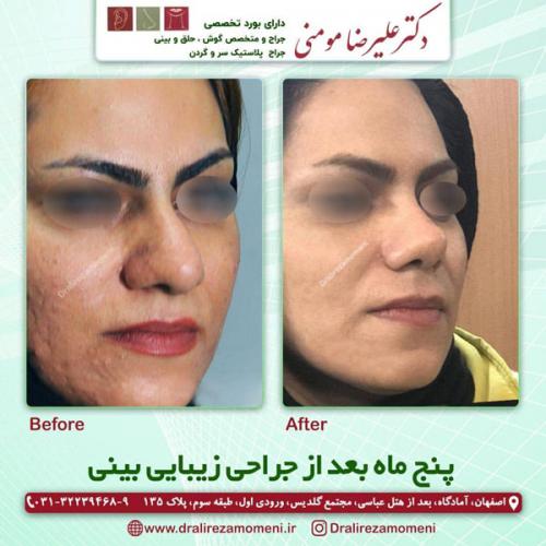 جراحی-بینی-293