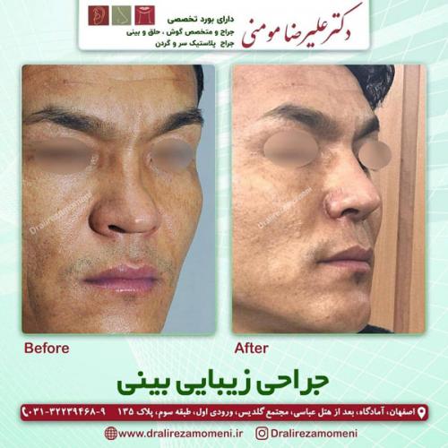 جراحی-بینی-300