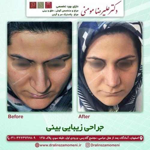 جراحی-بینی-304
