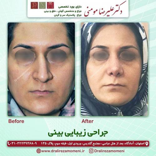 جراحی-بینی-305