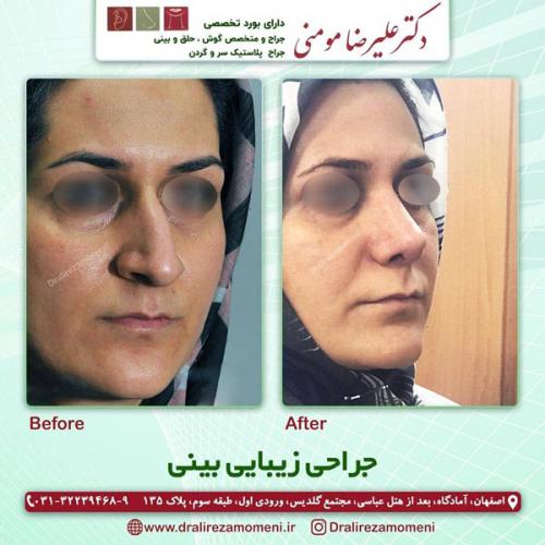 جراحی-بینی-306