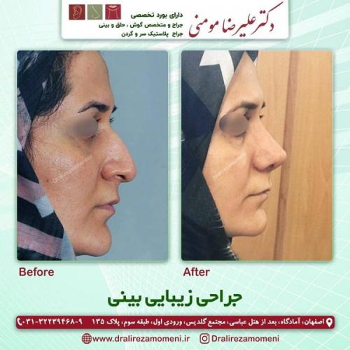 جراحی-بینی-309