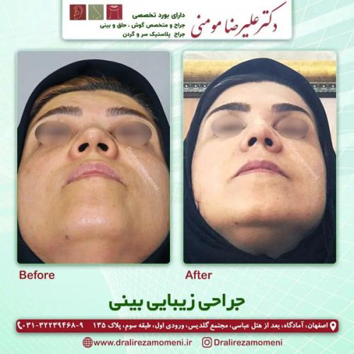 جراحی-بینی-311