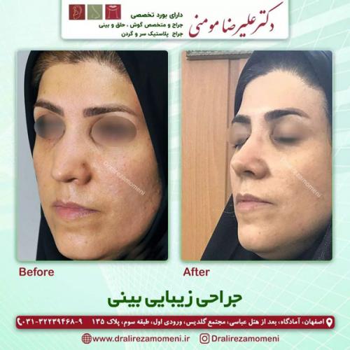جراحی-بینی-313