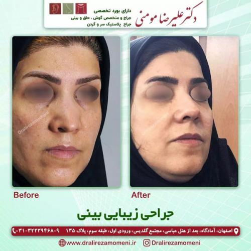جراحی-بینی-314