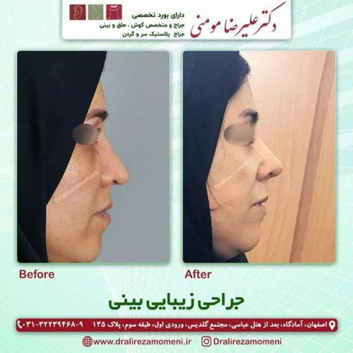 جراحی-بینی-315