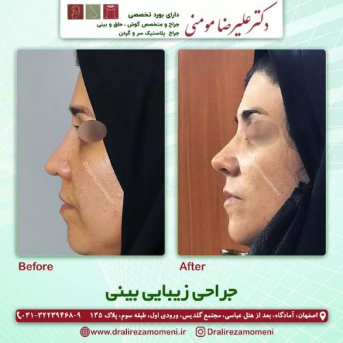 جراحی-بینی-316