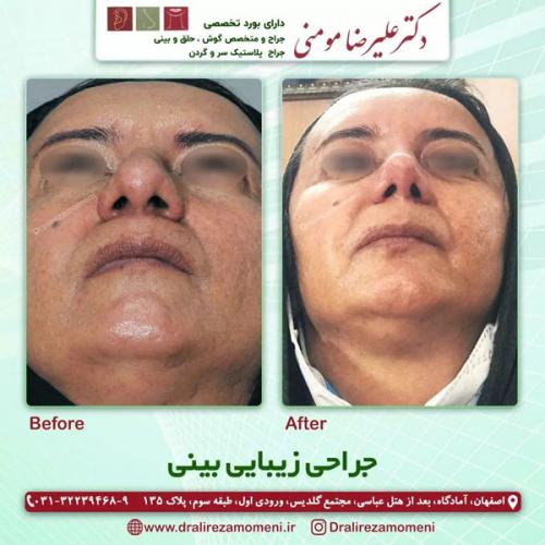 جراحی-بینی-318