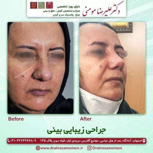 جراحی-بینی-320