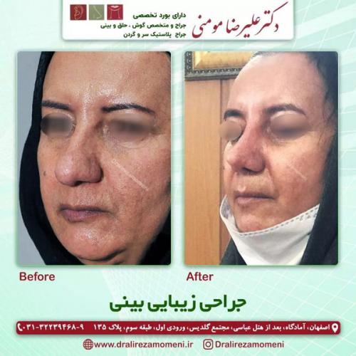 جراحی-بینی-321