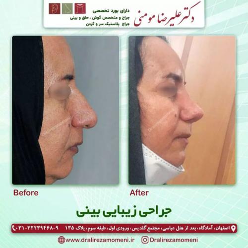 جراحی-بینی-322
