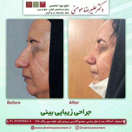 جراحی-بینی-323