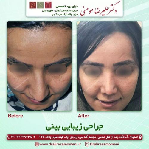 جراحی-بینی-325