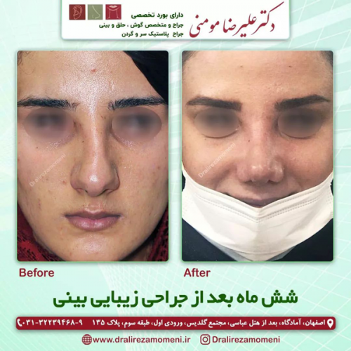 جراحی-بینی-330