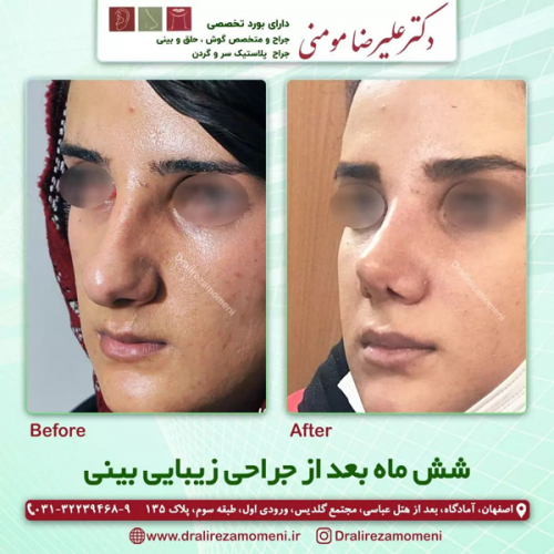 جراحی-بینی-334