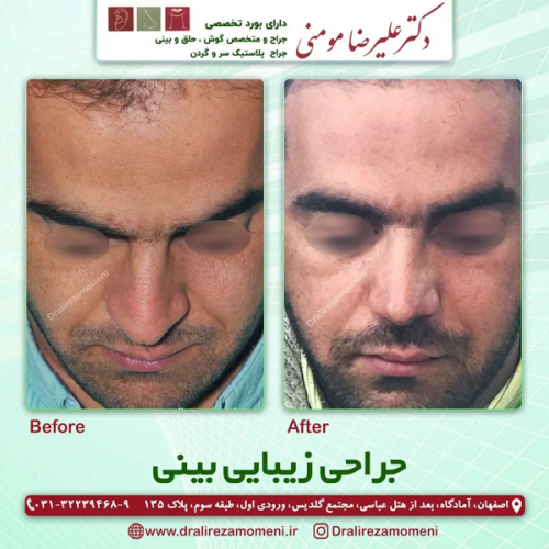 جراحی-بینی-335