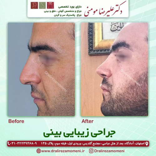 جراحی-بینی-339