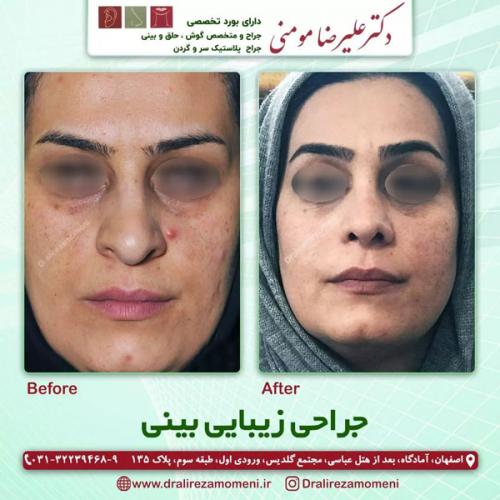 جراحی-بینی-340