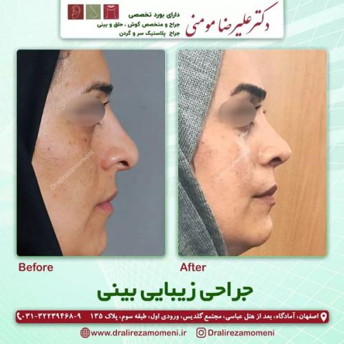 جراحی-بینی-343