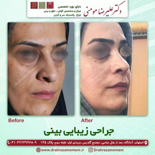 جراحی-بینی-345