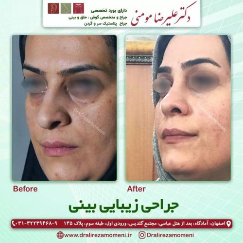 جراحی-بینی-346