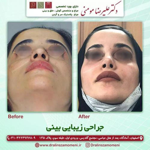 جراحی-بینی-348