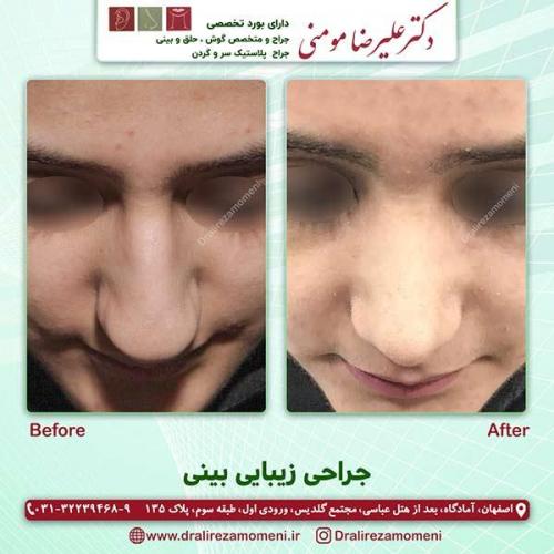 جراحی-بینی-35
