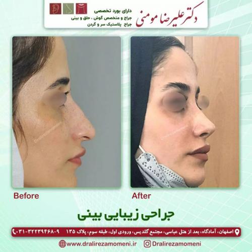 جراحی-بینی-350