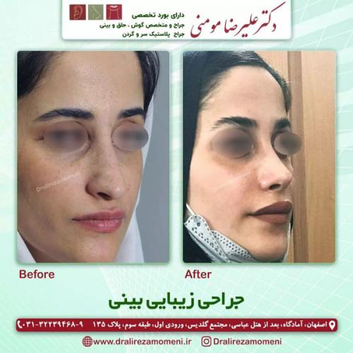 جراحی-بینی-352