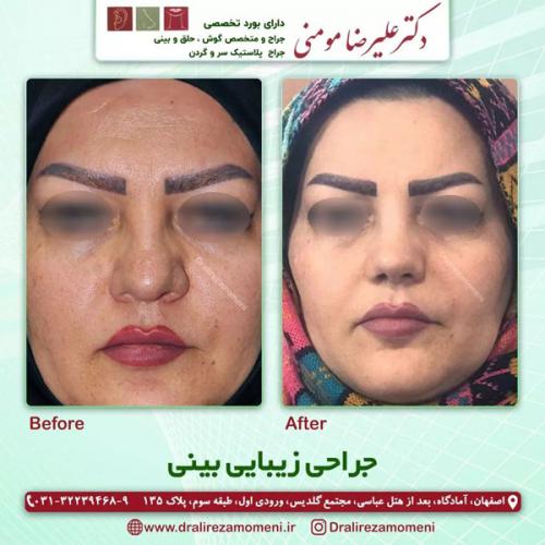 جراحی-بینی-353